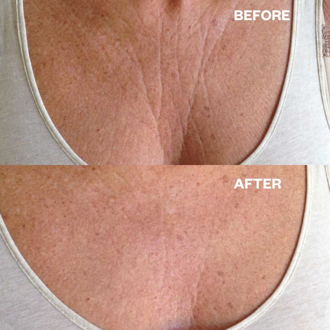 Stepply Silicone Patch