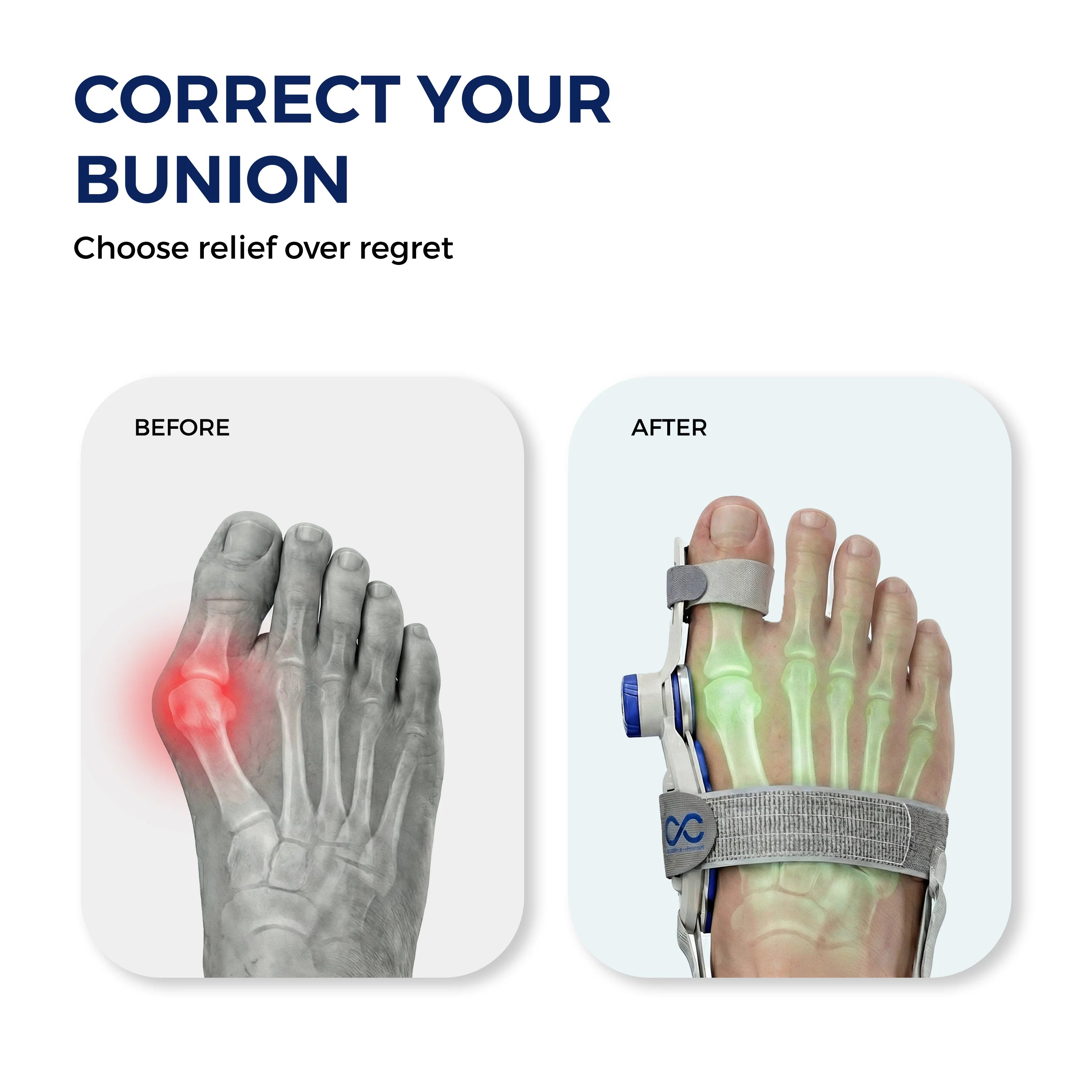 Bunion Corrector